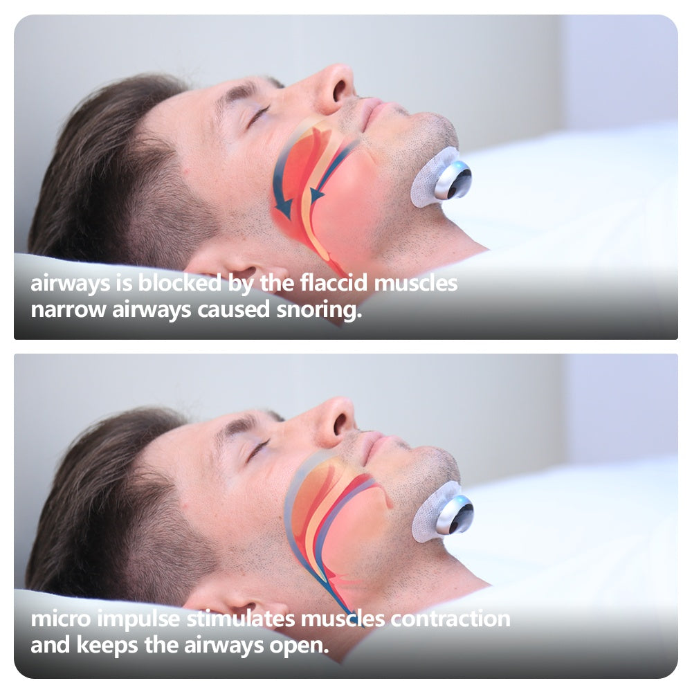 Smart Anti-Snoring Muscle Stimulator Plus Dream Tech Sleep